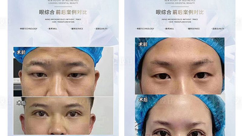 局麻双眼皮手术，术前术后这些注意事项你了解吗？**