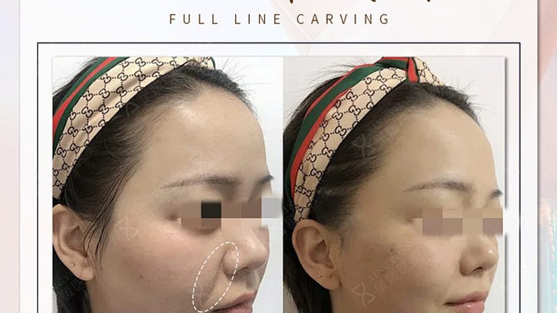 小标题：拆线后消肿的原理