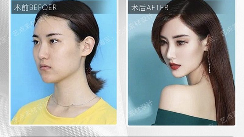 全麻医美术后，这些注意事项你了解吗？**