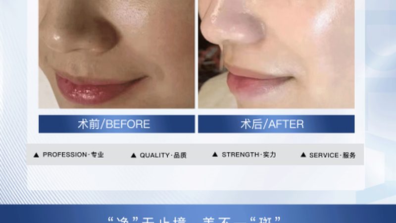 激光脱毛机：美容院必备，如何挑选合适的生产厂家？**