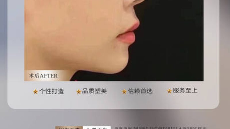 黄褐斑激光治疗，揭秘治疗次数的真相