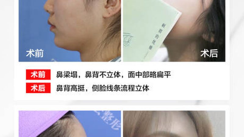 水光针，补水还是抗衰？揭秘水光针与普通补水的本质区别