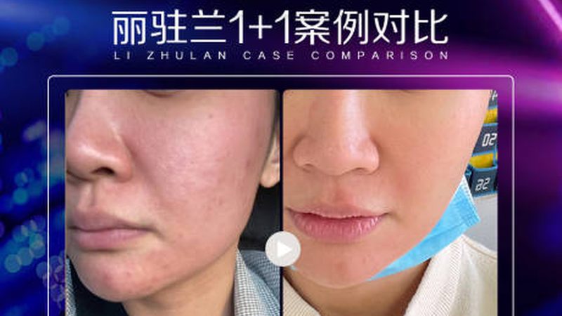 光子嫩肤后敷面膜用什么牌子好