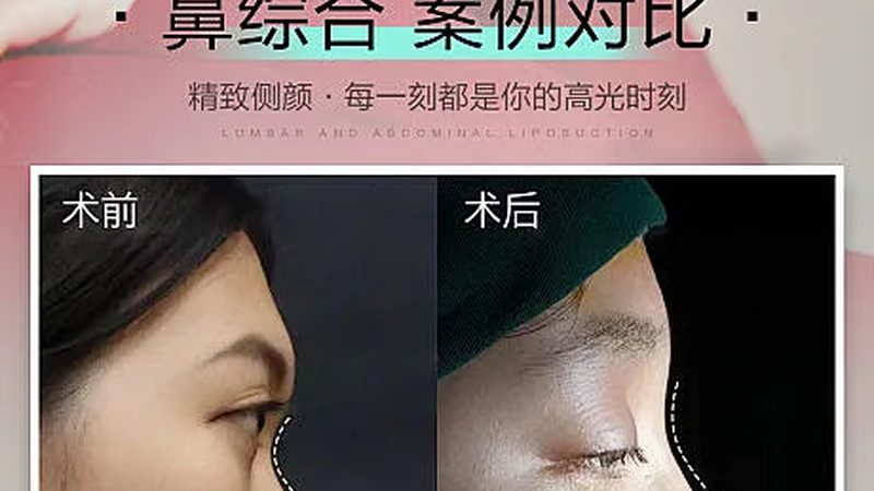 光子嫩肤去红血丝后，化妆前需知的时间节点